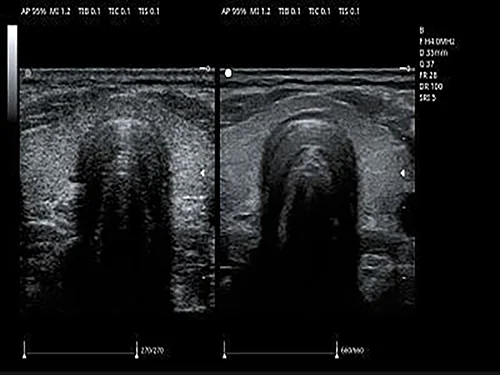 Speckle Reduction Imaging